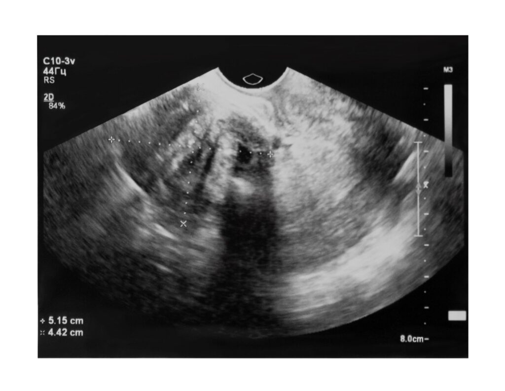 Ultrasound image of myoma