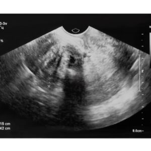 Ultrasound image of myoma